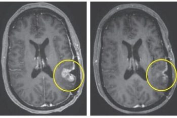 کشف روش درمان تومور‌های کشنده مغز تنها در ۵ روز